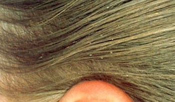 lice eggs in hair